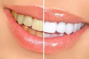 مضرات پودرهای سفید کننده دندان