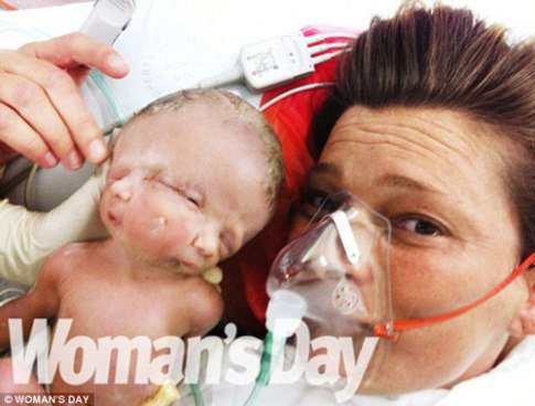 تولد دختر عجیب با دو صورت در استرالیا